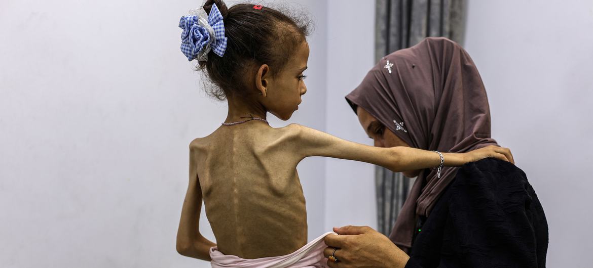 Severely malnourished young girl in Gaza